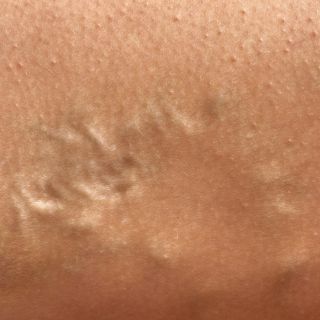 Diminuisce l’infiammazione e il gonfiore